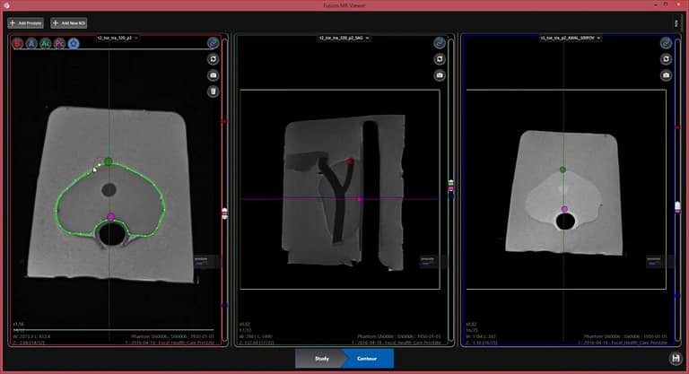 Screen capture from Fusion MR software- segmenting MRI