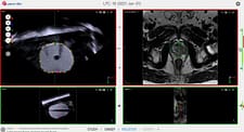 Screen capture from Fusion Bx software- segmenting live ultrasound